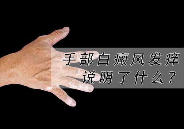 手部白癜风瘙痒说明了什么? 手部白癜风瘙痒说明了什么?