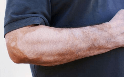 男性手部上的白癜风会有什么症状?