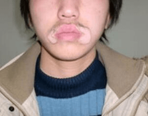 男性患白癜风的危害有哪些?