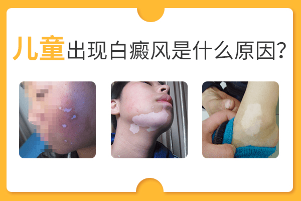 儿童白癜风致病原因有哪些? 儿童白癜风致病原因有哪些?