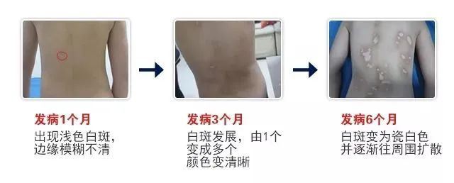 一个多数人都有的坏习惯,却能引发白癜风扩散! 一个多数人都有的坏习惯,却能引发白癜风扩散!