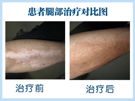 腿上出现白斑应该怎么办呢? 腿上出现白斑应该怎么办呢?