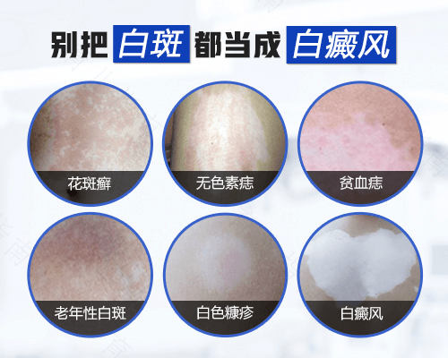 腰部的白斑会是白癜风吗? 腰部的白斑会是白癜风吗?
