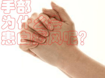 如何合理治疗手部出现的白癜风呢? 如何合理治疗手部出现的白癜风呢?