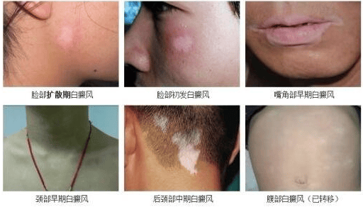 [名单即时公开]泉州治白斑去哪个医院最好？小童脸上有一块白点怎么去掉？