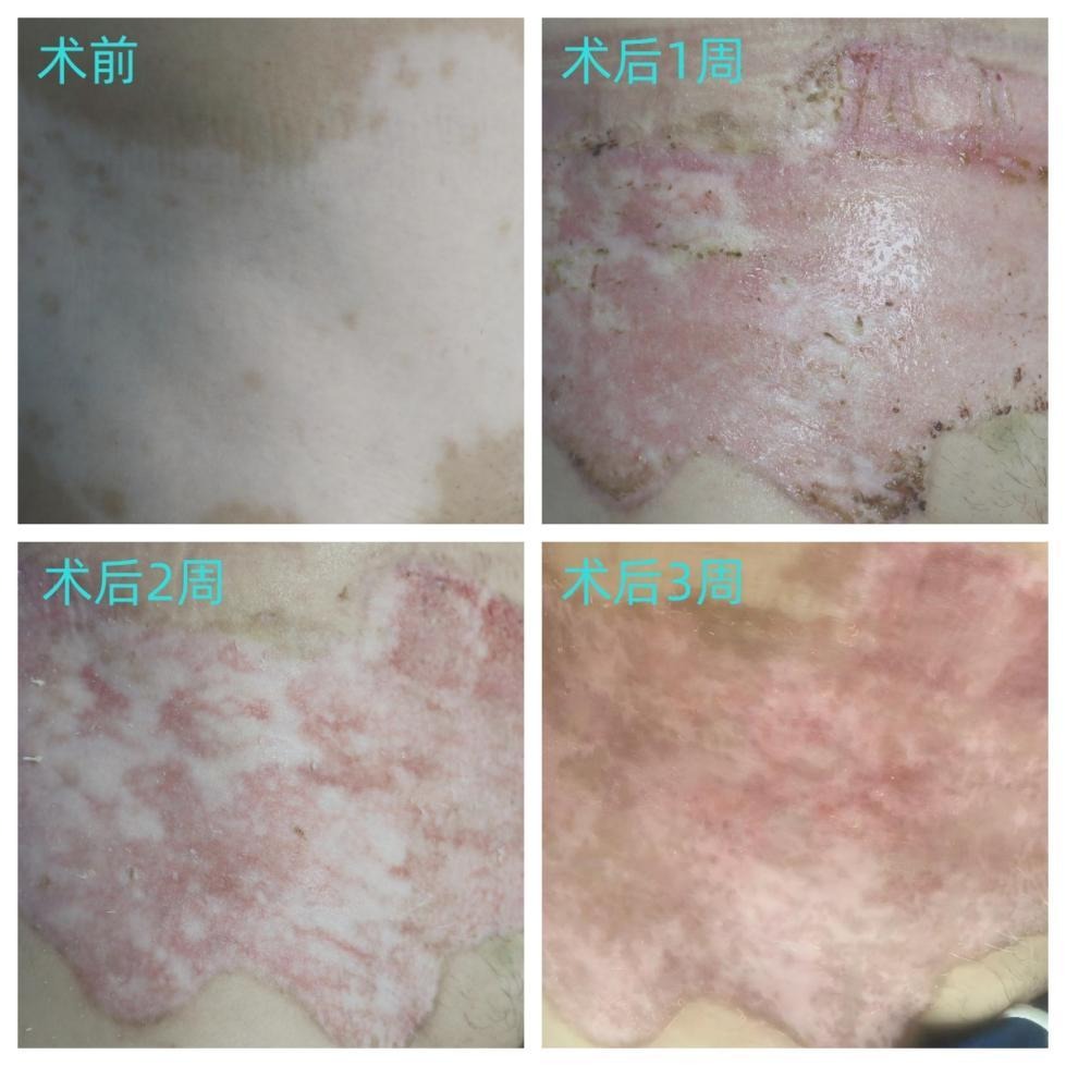 告别传统治疗痛点！PrimCell白癜风细胞悬液移植技术，小取材大覆盖、当天治疗，实现均匀持久复色