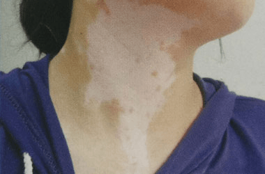 泉州女性颈部白癜风要如何护理？